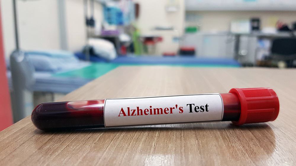 frasco com sangue para exame de Alzheimer