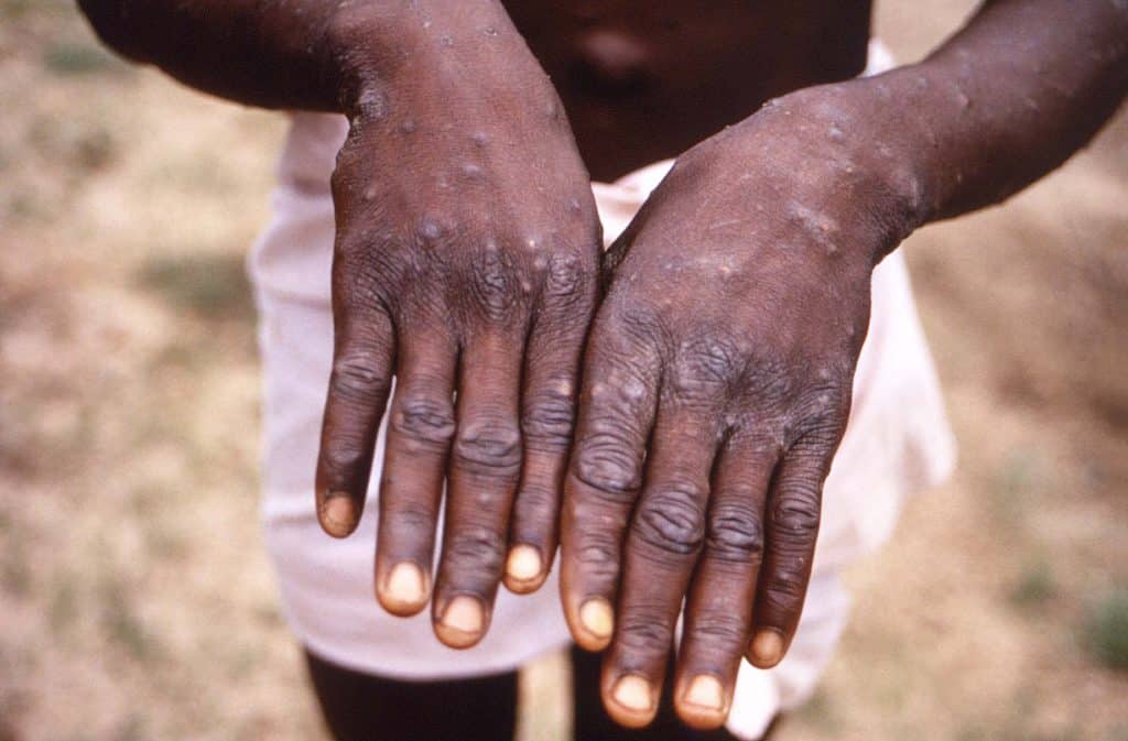 Mãos de homem com varíola