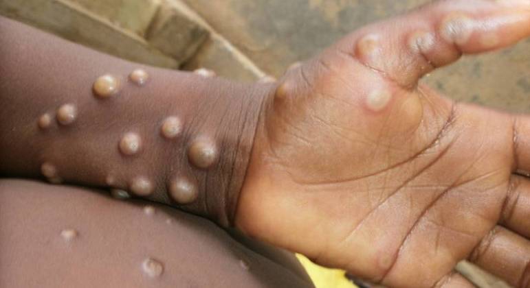 Israel confirma primeiro caso de varíola dos macacos